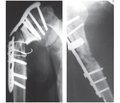 Outstanding issues of modern osteosynthesis of humerus fractures
