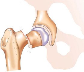 Фармакологическая коррекция нарушений ремоделирования при замедленной консолидации чрезвертельного перелома бедренной кости на фоне системного остеопороза