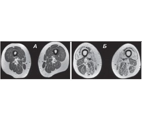 Можливості магнітно-резонансної томографії у ранній діагностиці прогресування м’язових дистрофій
