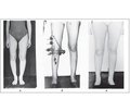 Frame Extrafocal Osteosynthesis for Lower Extremity Axis Correction