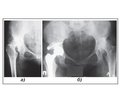 Application of Bone Grafting in Patients with Congenital Dysplasia in Hip Joint Arthroplasty