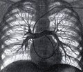 Эффективность динамической компьютерно-томографической ангиопульмонографии в диагностике и лечении тромбоэмболии легочной артерии