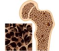 Osteoporosis in stroke patients