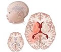 Consequences of intra- and postnatal cerebral ischemia with psychomotor and speech delay (Q04.9)