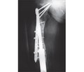 Analysis and timeframe of appearance of complications after knee joint replacement in patients with bone tumors