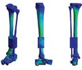 Порівняльний аналіз напружено-деформованого стану моделей кісток гомілки при їх уродженому псевдоартрозі в нижній третині в умовах остеосинтезу інтрамедулярними ростучими стрижнями з блокуванням подовжнього руху при стисканні та без нього