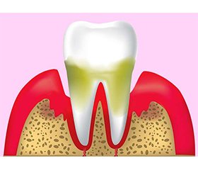 Взаємозв’язок генералізованого пародонтиту та підвищеного рівня продукції паратиреоїдного гормону