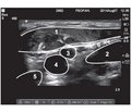 Ultrasound regional block anesthesia for carotid endarterectomy