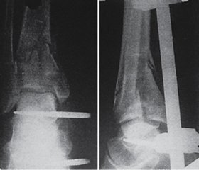 Дискусійні питання хірургічного лікування переломів pilon