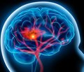 Possibilities of antioxidant pharmacotherapy in chronic brain ischemia