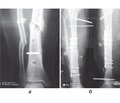 Possibilities of the treatment for small-contact multiplanar osteosynthesis of lower leg fractures and methods of its implementation