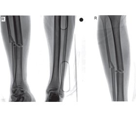 Von Willebrand’s disease mimicking postoperative bleeding after tibial nailing for tibial shaft fracture