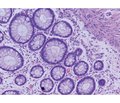 Histo- and morphometric changes in the large intestine mucosa in Crohn’s disease depending on the presence of fibrosis