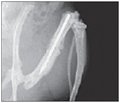 Посттравматическая остеопения при переломах длинных трубчатых костей