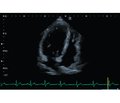 Apical hypertrophic cardiomyopathy. A case report and a literature review