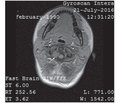 Випадок нейрофіброматозу 2-го типу  з множинними пухлинами  центральної нервової системи  у вагітної жінки