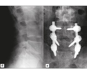 Причини повторних оперативних утручань у пацієнтів, які перенесли хірургічне лікування гриж міжхребцевих дисків поперекового відділу хребта