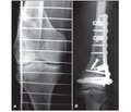 Trends of Modern Osteosynthesis of the Distal Femur