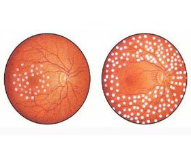 Прогностическое значение показателей протеолиза в формировании диабетической ретинопатии