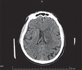Clinical case of the stage-by-stage combined ischemic stroke treatment of the elderly patient
