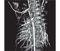Scimitar syndrome: diagnostic approach and management