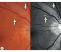 Eye manifestations of COVID-19. Step one