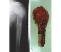 The results of replacement arthroplasty in the treatment of bone chondrosarcoma