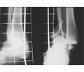 The use of the combined stable-elastic fixation for unstable injuries of the ankle joint in trans-syndesmotic fractures of the tibia