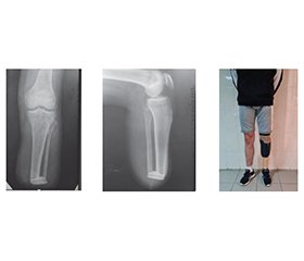 Реконструктивні операції ампутаційних кукс гомілок внаслідок бойової травми