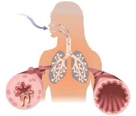Особливості лікування бронхіальної астми у дітей  з надлишковою масою тіла та ожирінням