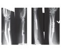 Наш досвід застосування блокуючого інтрамедулярного остеосинтезу при лікуванні хворих із переломами кісток передпліччя в умовах Обласної лікарні інтенсивного лікування м. Маріуполя