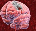 Динаміка нейропсихологічних функцій та показників системної запальної відповіді в пацієнтів у відновному періоді ішемічного інсульту за умов лікування препаратом Гліатилін