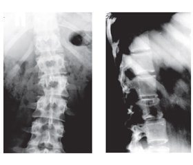 Analysis of surgical treatment of patients with primary tumors of the thoracic and lumbar spine