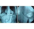 Surgical correction of the physiological incompetent cardia in hiatal hernia