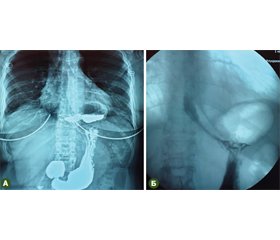 Хірургічна корекція неспроможності фізіологічної кардії при грижах стравохідного отвору діафрагми