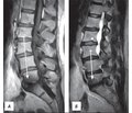Modic changes in the lumbar spine: histology, risk factors, clinical presentation and treatment