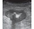 Possibilities of ultrasound diagnostics in inflammatory bowel diseases