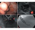 Endoscopic ultrasound-guided endovascular treatment of gastric varices