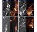 The role of hybrid SPECT/CT imaging in the diagnostic monitoring of patients with pathology of the bones of the lower limbs (review of literature)
