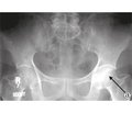 Role of Bone Scintigraphy and X-Ray Imaging in Patients with Avascular Necrosis of the Femoral Head in Hip Arthroplasty