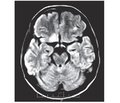 MRI Semiotics of Wernicke-Korsakoff Syndrome in Patients with HIV