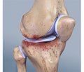 Визначення стану синовіальної оболонки колінного суглоба у хворих на ревматоїдний артрит