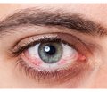 Современные возможности диагностики и лечения синдрома сухого глаза при дисфункции мейбомиевых желез и воспалительных заболеваниях передней поверхности глаза