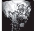 Pathogenesis and Treatment Approaches in Gunshot Wounds of the Maxillofacial Area in Specialized Multidisciplinary Hospital