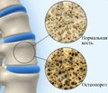 Вплив системного остеопорозу на репаративну регенерацію кісткової тканини