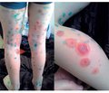 Bullous varicella in a child (a case report)