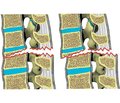 AOSpine Thoracolumbar Spine Injury Classification System in determining the treating tactics of thoracolumbar junction traumatic injuries (literature review)