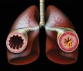Прогнозування несприятливого перебігу перших нападів бронхіальної астми в дітей раннього віку