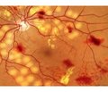 Efficacy of closed subtotal vitrectomy combined with panretinal laser coagulation in the treatment of diabetic maculopathy in patients with type 2 diabetes mellitus