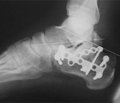Лечение диафизарных переломов костей нижней конечности у детей и подростков аппаратами внешней фиксации